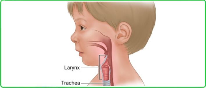 Acute Laryngitis in Children