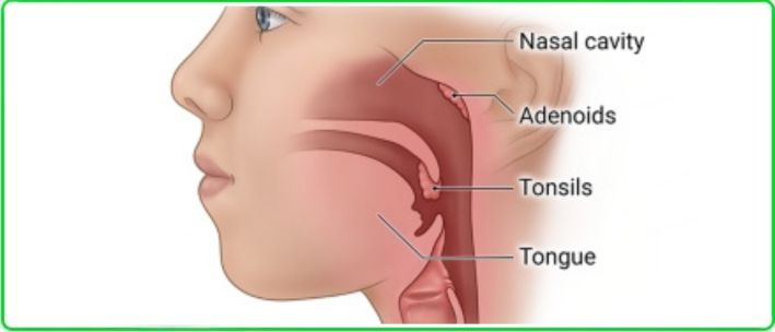 Adenoids in Children