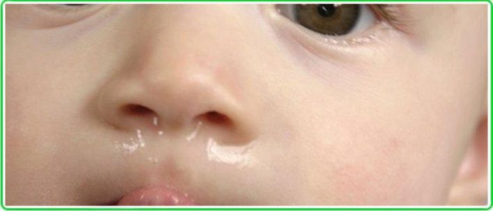Chronic Runny Nose in Children