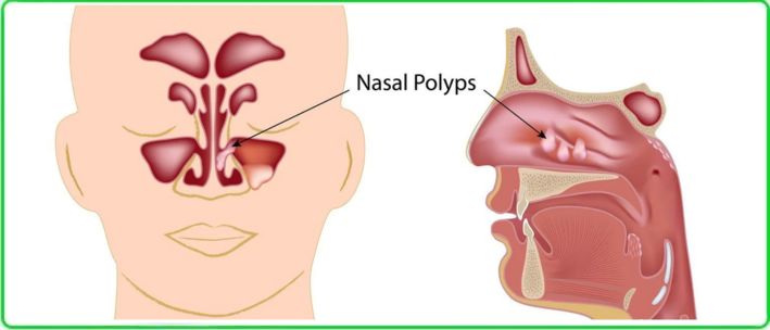 Nasal Polyps