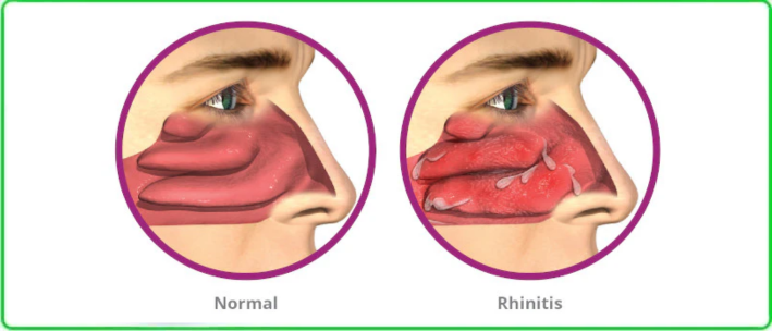 allergic rhinitis