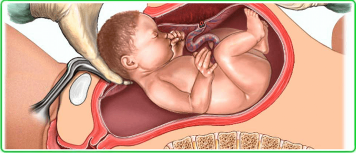 cesarean section