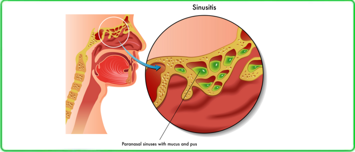 chronic sinusitis