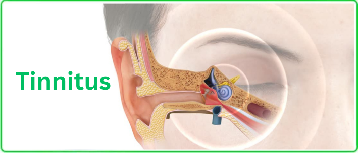 tinnitus