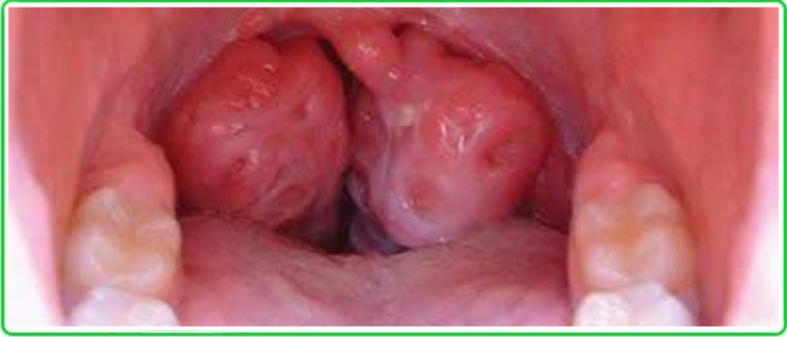 chronic tonsillitis