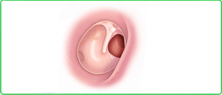 tympanic membrane perforation