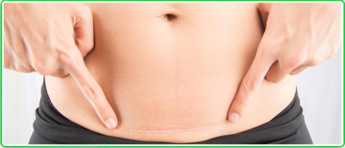 Recovery after cesarean section