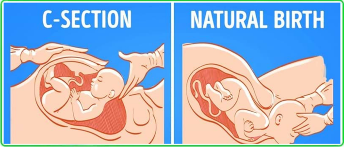 Natural Birth vs Cesarean Section