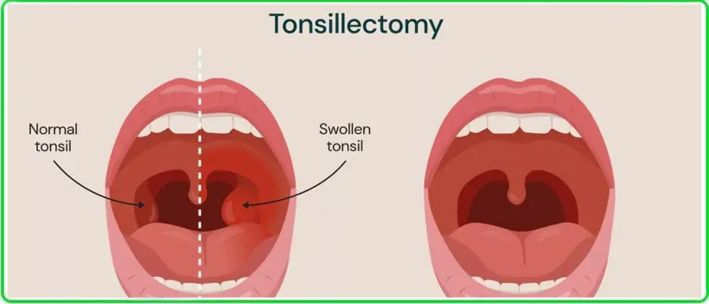 Tonsillectomy