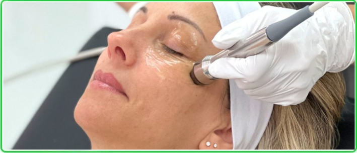 RF Eye Treatment