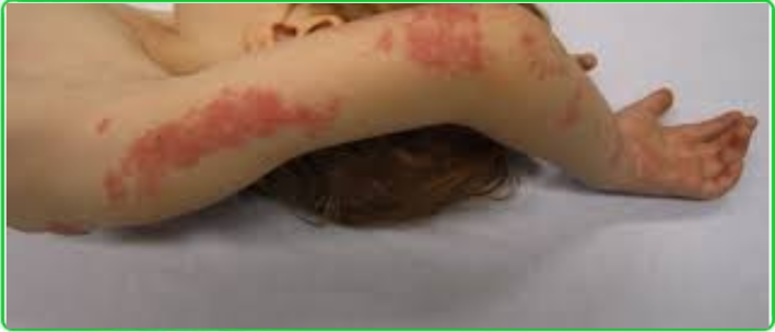 Viral Rashes in Children