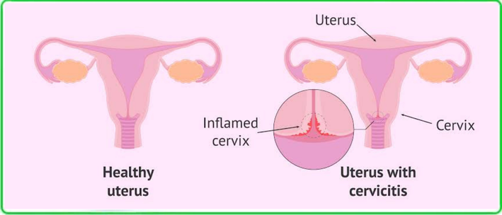 Cervix
