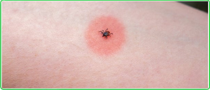 insect bites